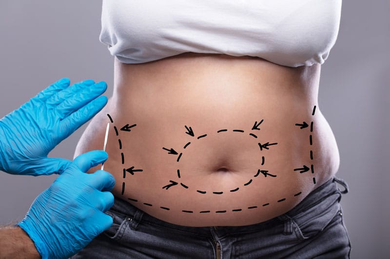 Abdominoplasty_TT