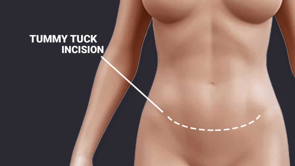 Tummy-tuck