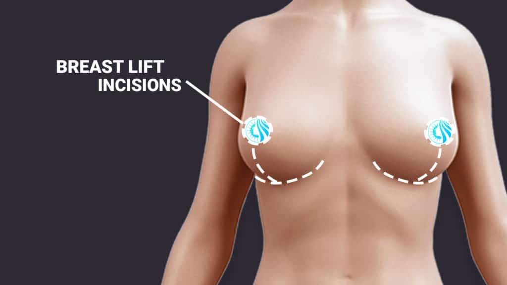 Breast Lift Surgery incisions