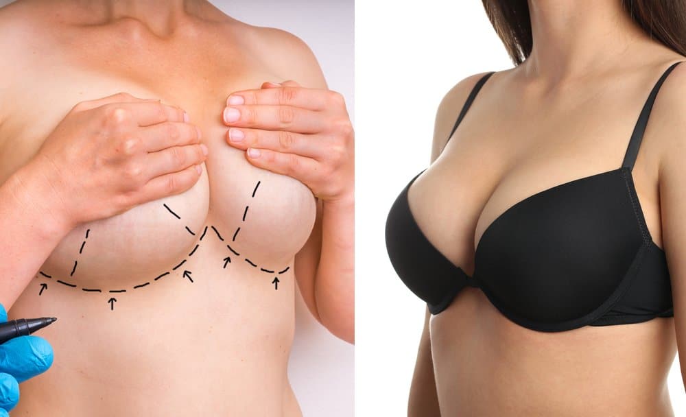 Breast Lift vs Breast Augmentation 1