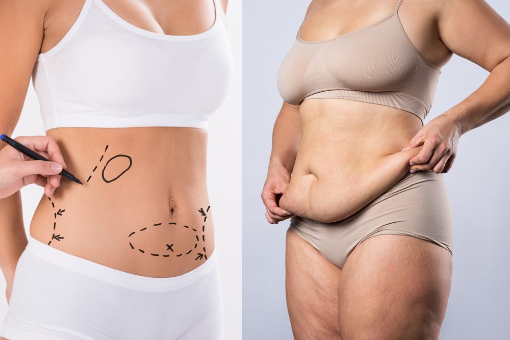 Liposuction vs Tummy Tuck v1