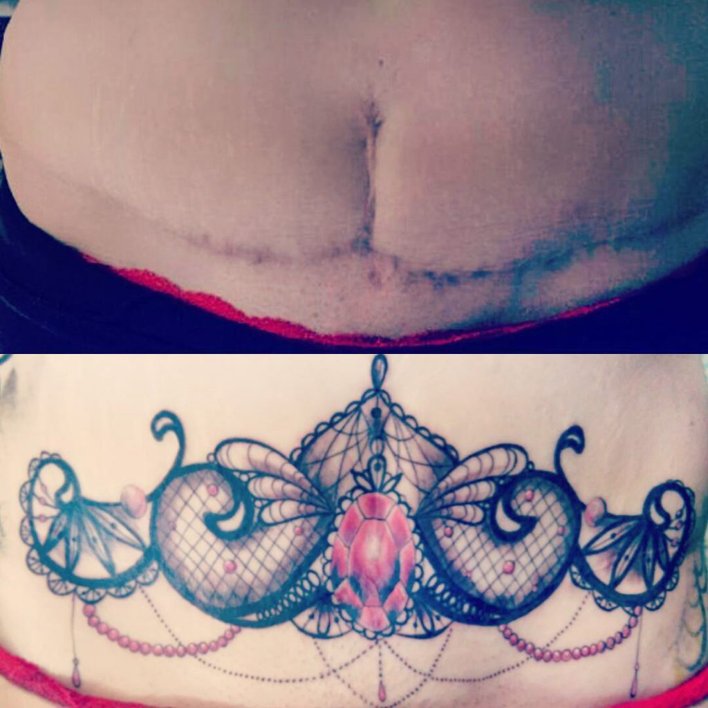 Tummy Tuck Tattoo Before and After