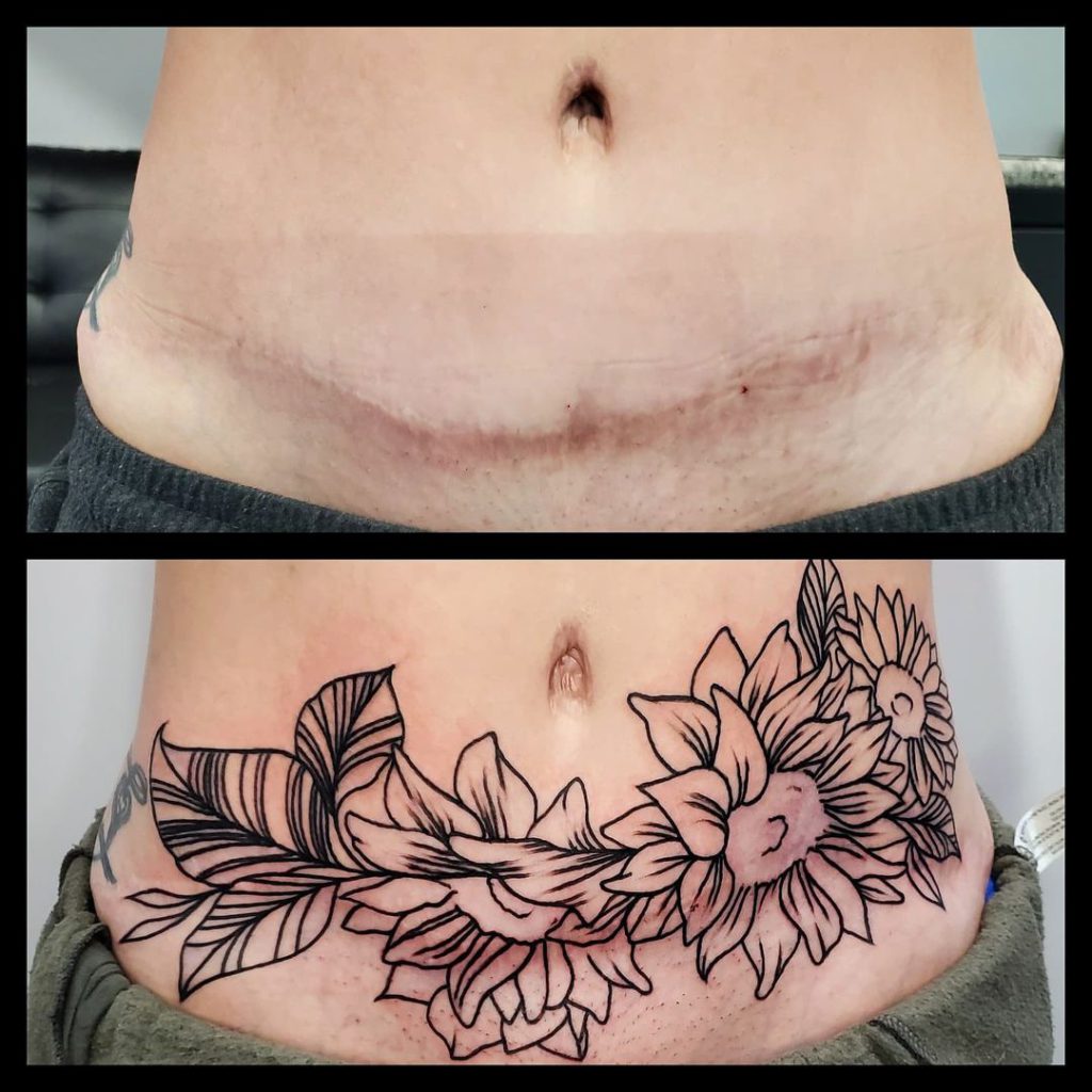 Tummy Tuck Tattoo Before and After black flowers