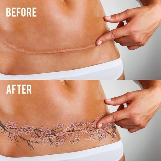 Tummy Tuck Tattoo Before and After flowers Idea
