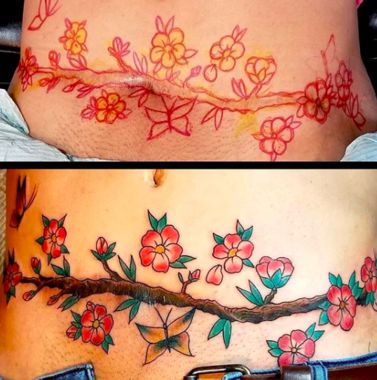 Tummy Tuck Tattoo Before and After flowers and branches