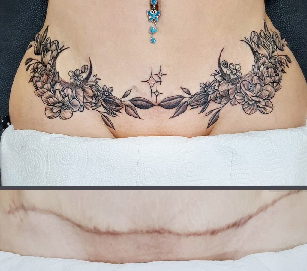 Tummy Tuck Tattoo Before and After flowers and star