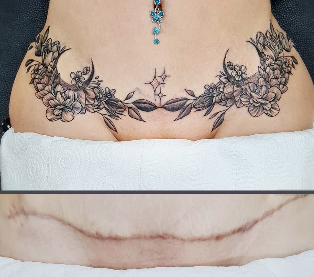 Tummy Tuck Tattoo on Brown Skin  YouTube