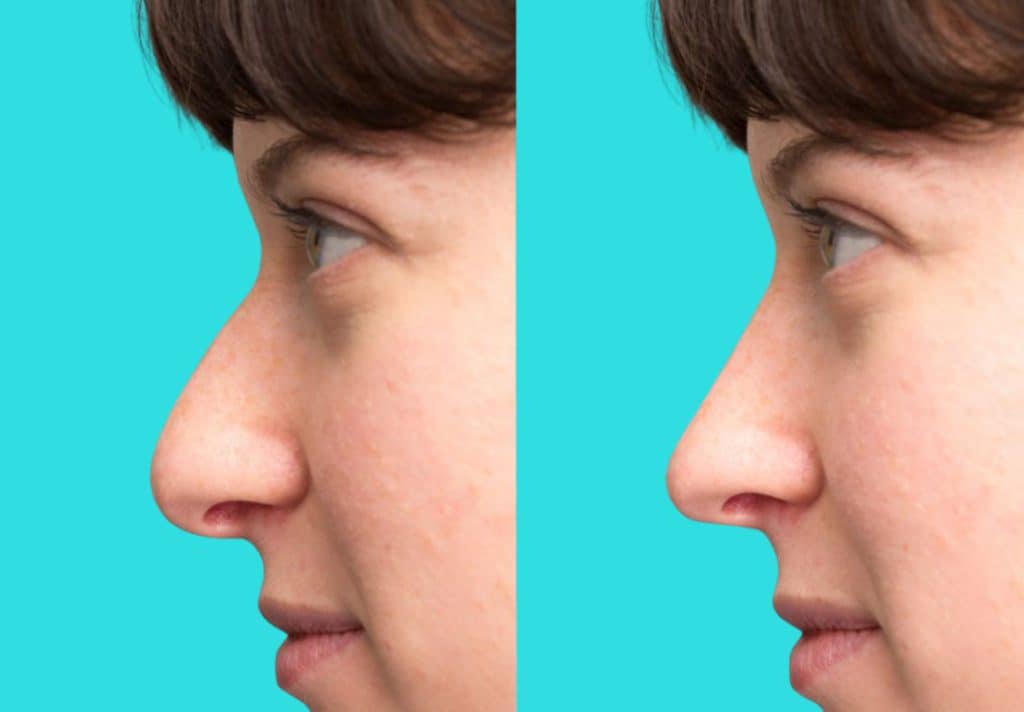 Thick Skin Rhinoplasty 1