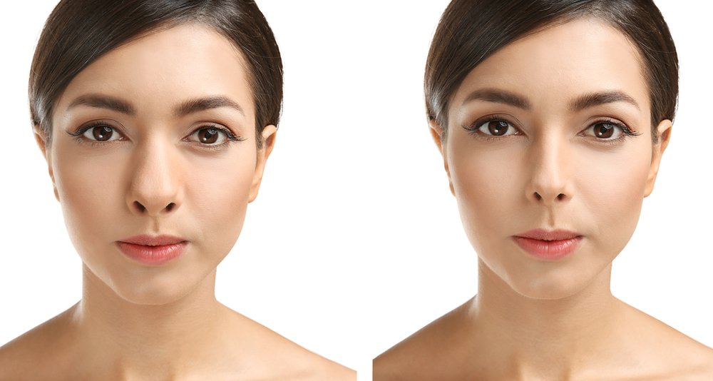 hispanic rhinoplasty before and after02