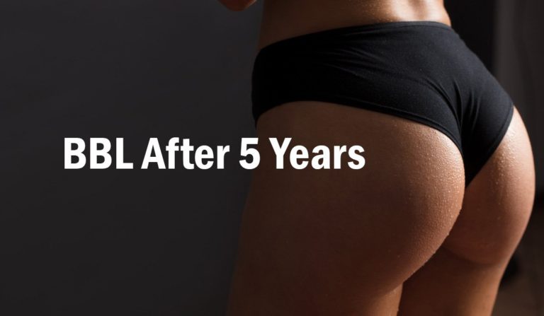 Woman BBL After Five Years