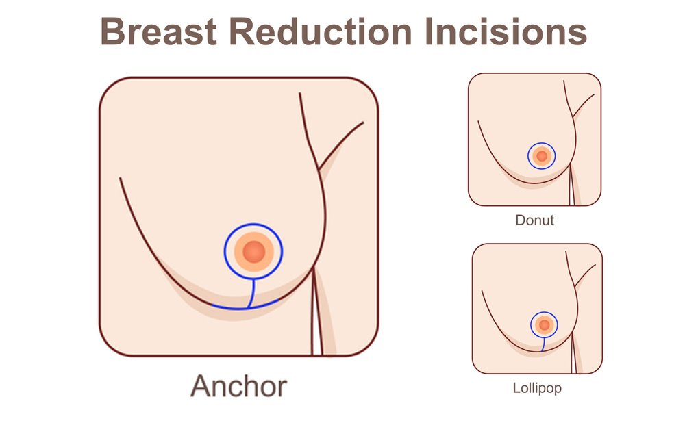 Anchor Incision Breast Reduction