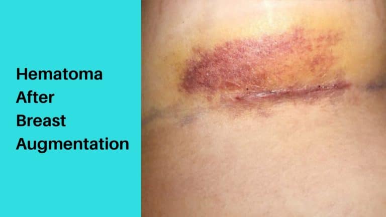 Woman with Hematoma After Breast Augmentation
