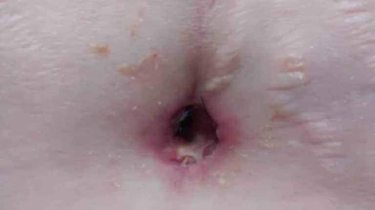 Infected Belly Button After Tummy Tuck