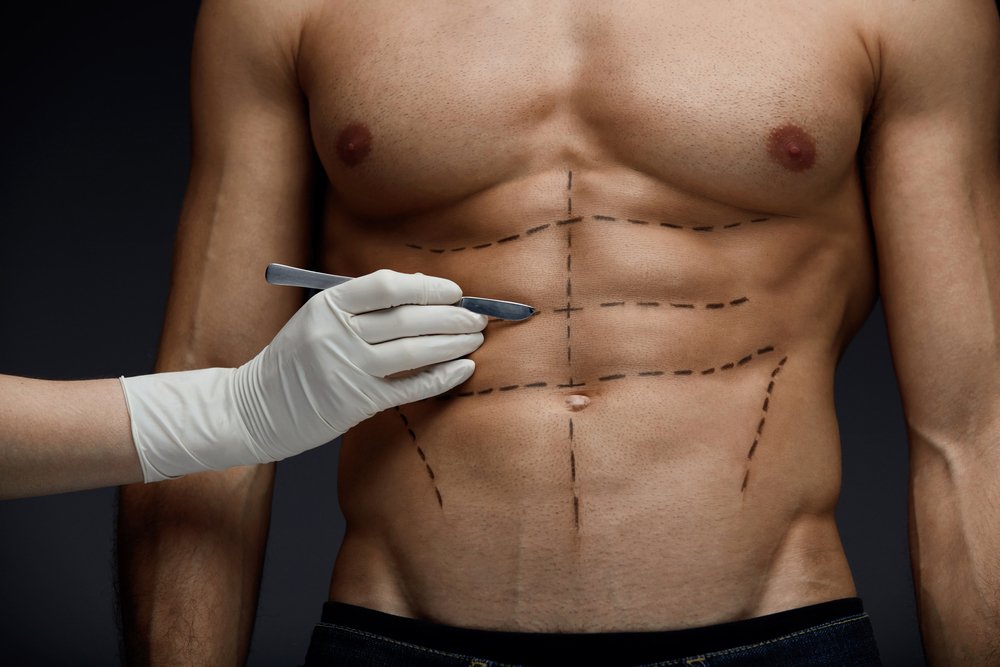 Male Liposuction Benefits​