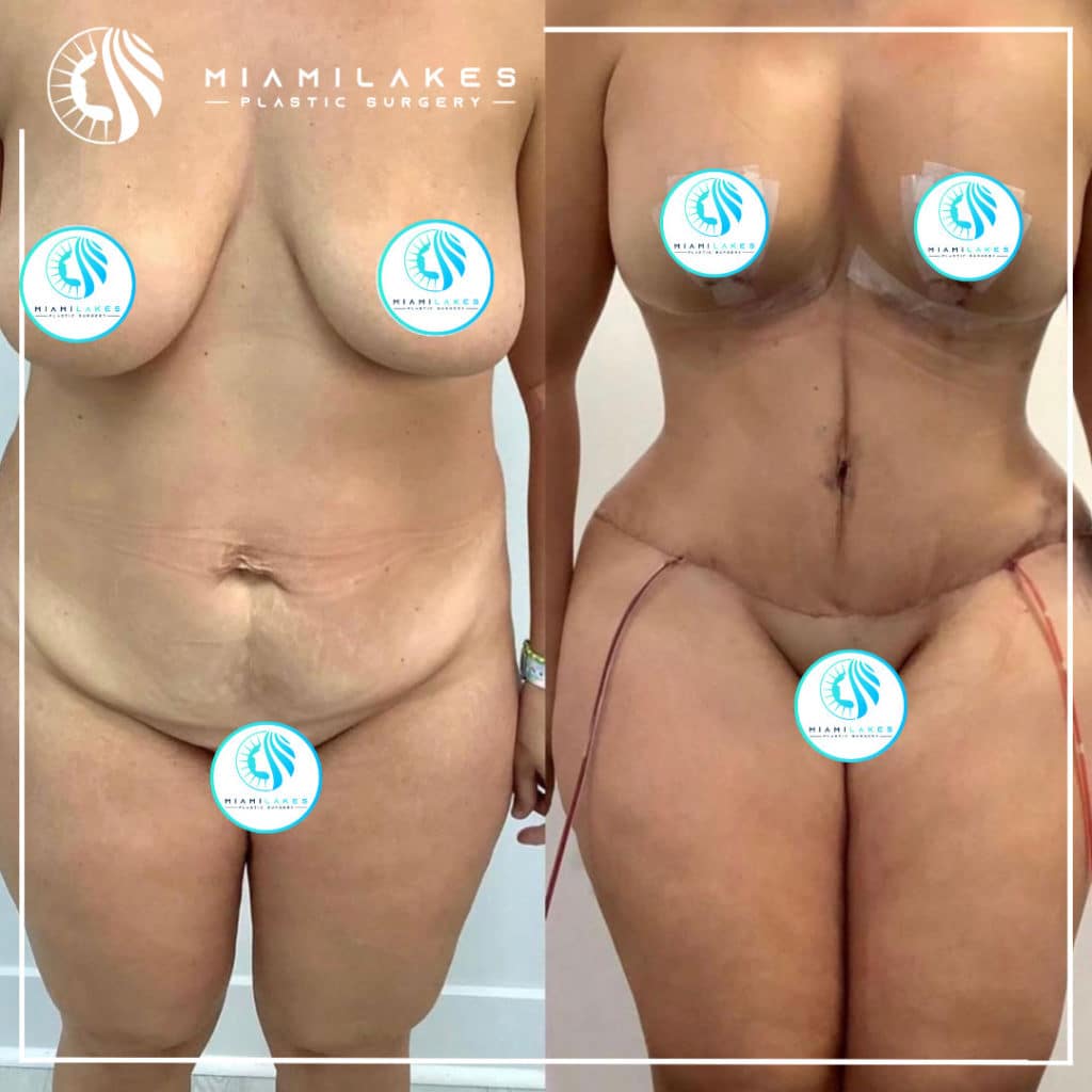 Tummy Tuck Miami  Miami Lakes Plastic Surgery