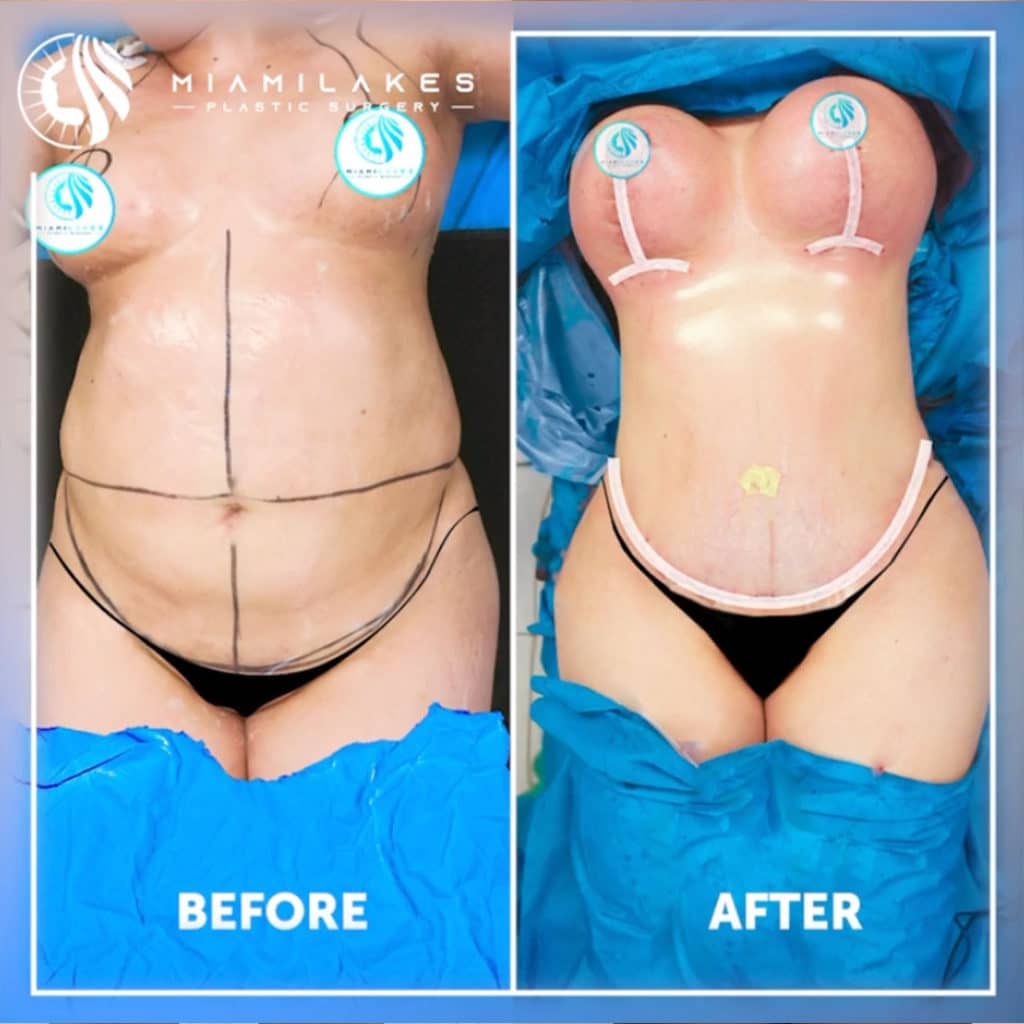 Tummy Tuck Miami  Miami Lakes Plastic Surgery