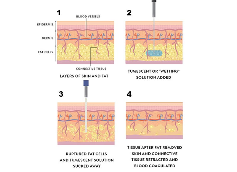 What Is Tumescent Liposuction​