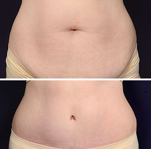 All About Belly Button After Tummy Tuck