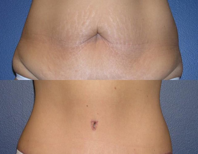 Belly Button After Tummy Tuck 05