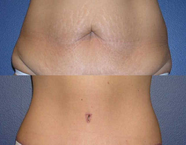 All About Belly Button After Tummy Tuck