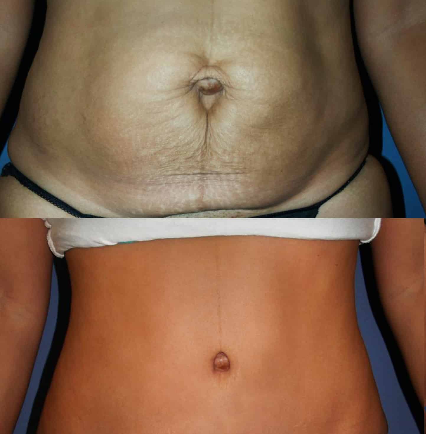 All About Belly Button After Tummy Tuck