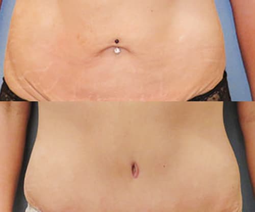 Belly Button After Tummy Tuck 07