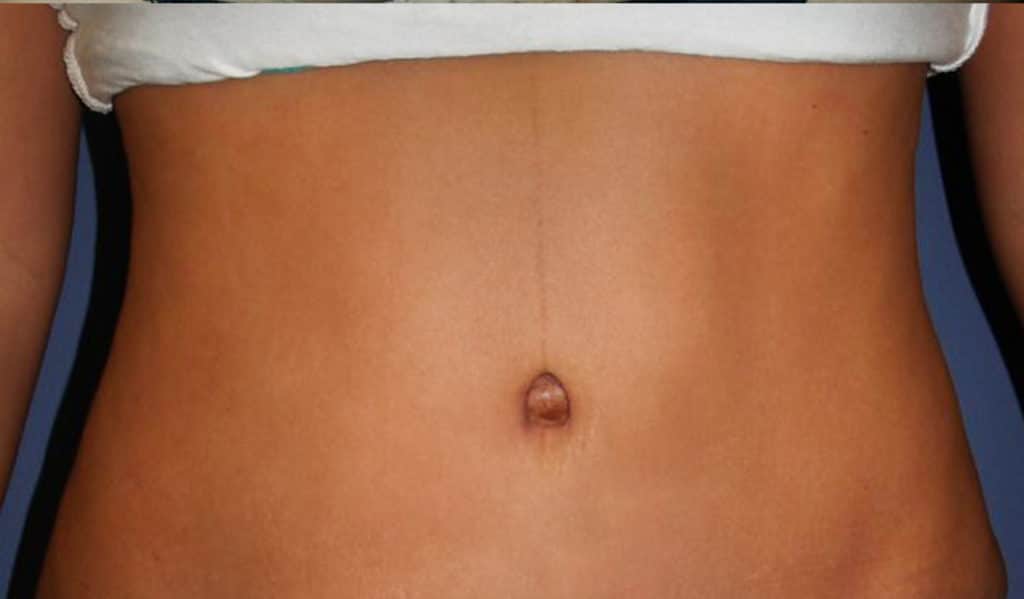 Belly Button Hernia After Tummy Tuck