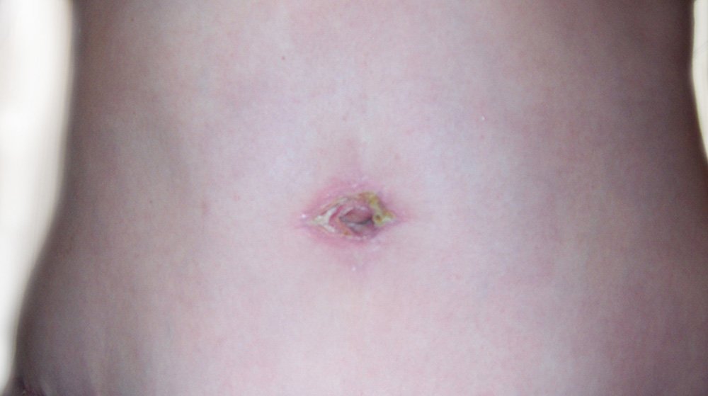 Infected Belly Button After Tummy Tuck 2