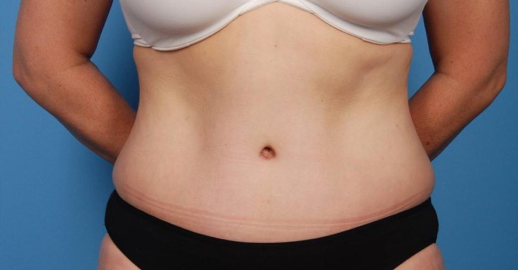 Tummy Tuck Belly Button Looks Weird