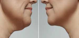 Neck Liposuction Recovery