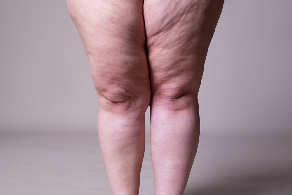 Tumescent liposuction for lipedema