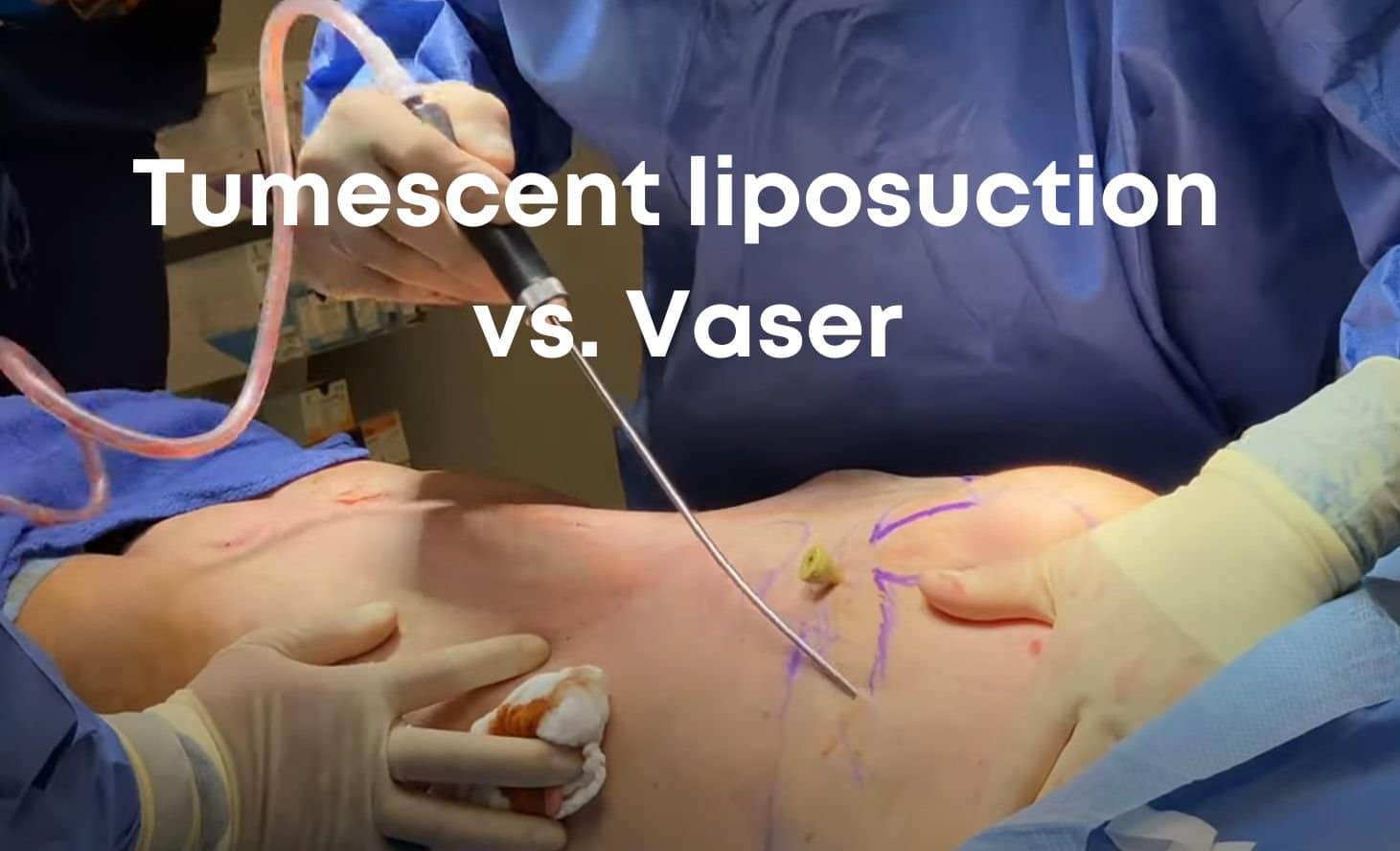 Tumescent liposuction vs. Vaser