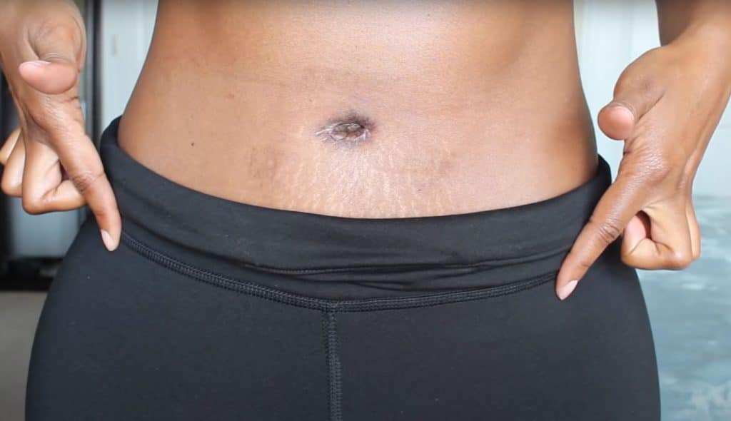 Tummy Tuck Belly Button Looks Weird