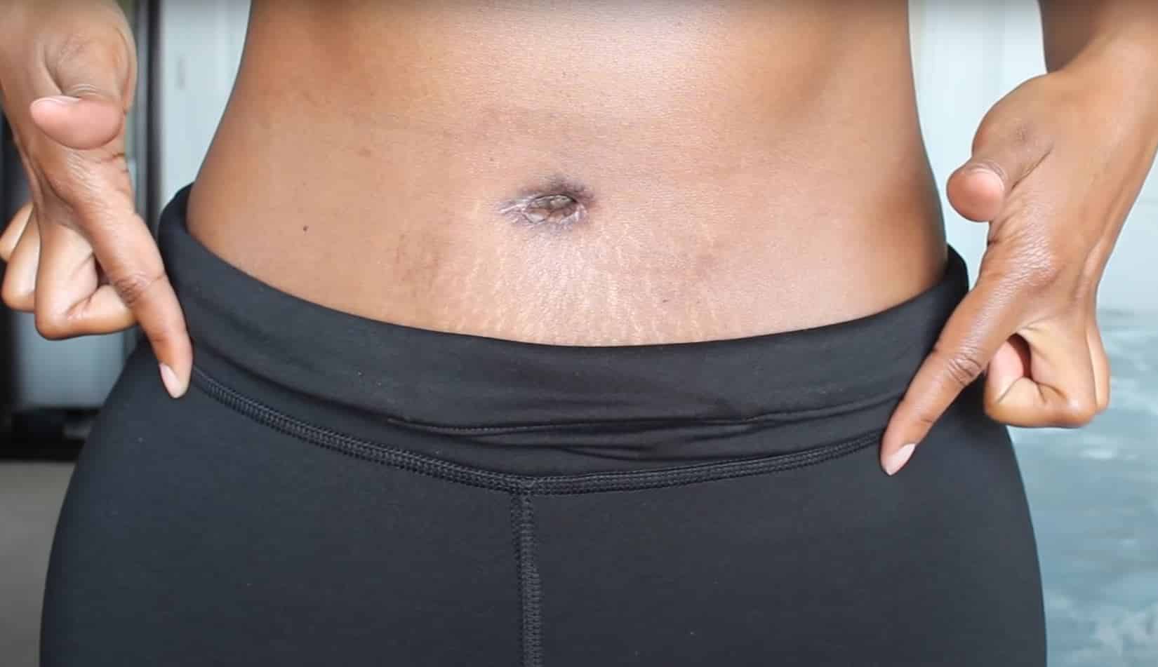 What happens to my belly button during a tummy tuck? - Staiano Plastic  Surgery