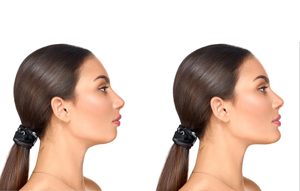 Chin Implant and Neck Liposuction