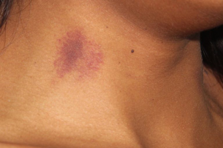 neck liposuction bruising
