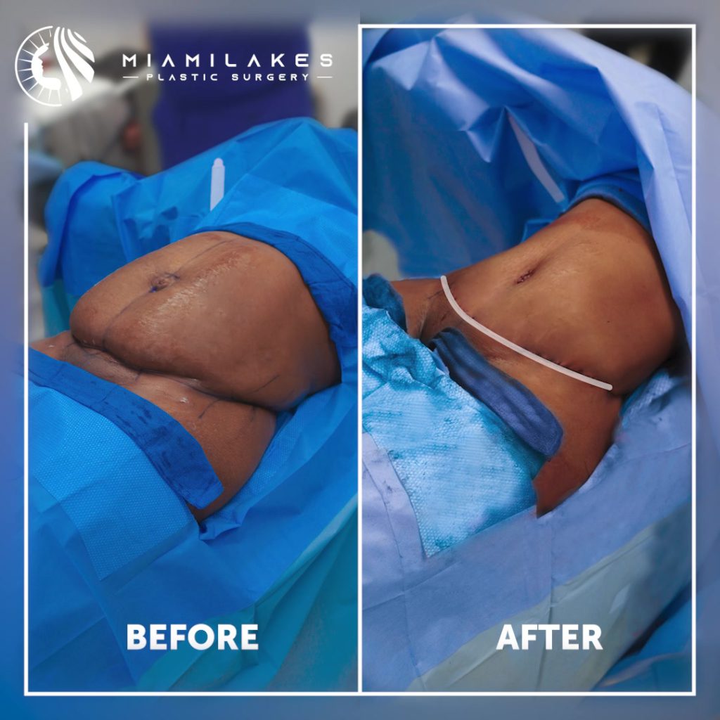 tummy tuck 1 06 08 2022