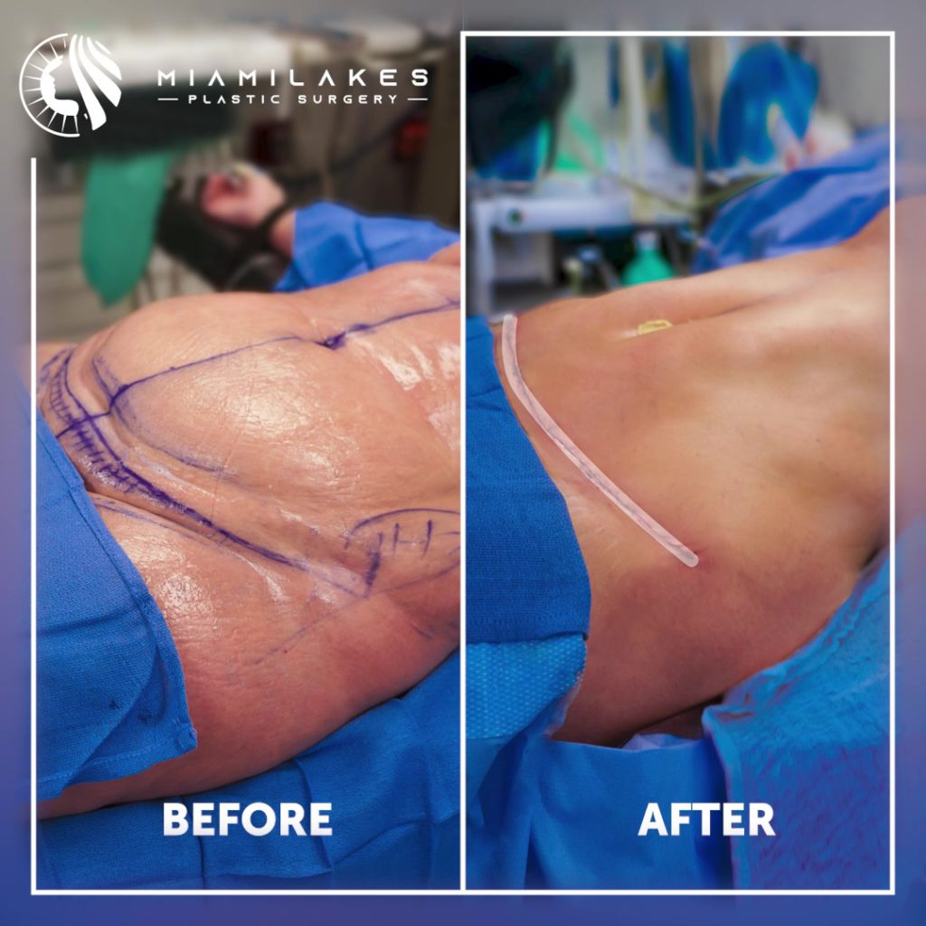 tummy tuck 1 06 09 2022