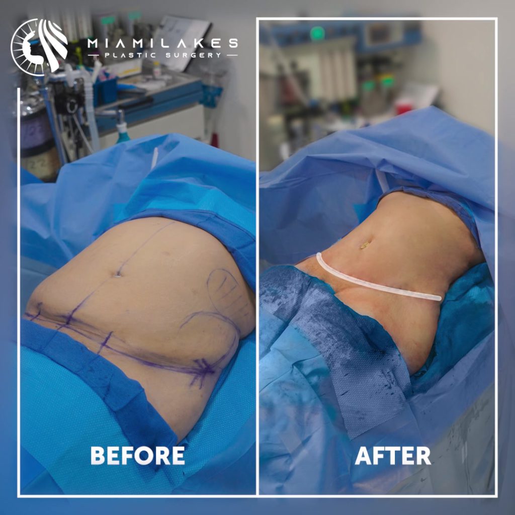 tummy tuck 2 06 08 2022