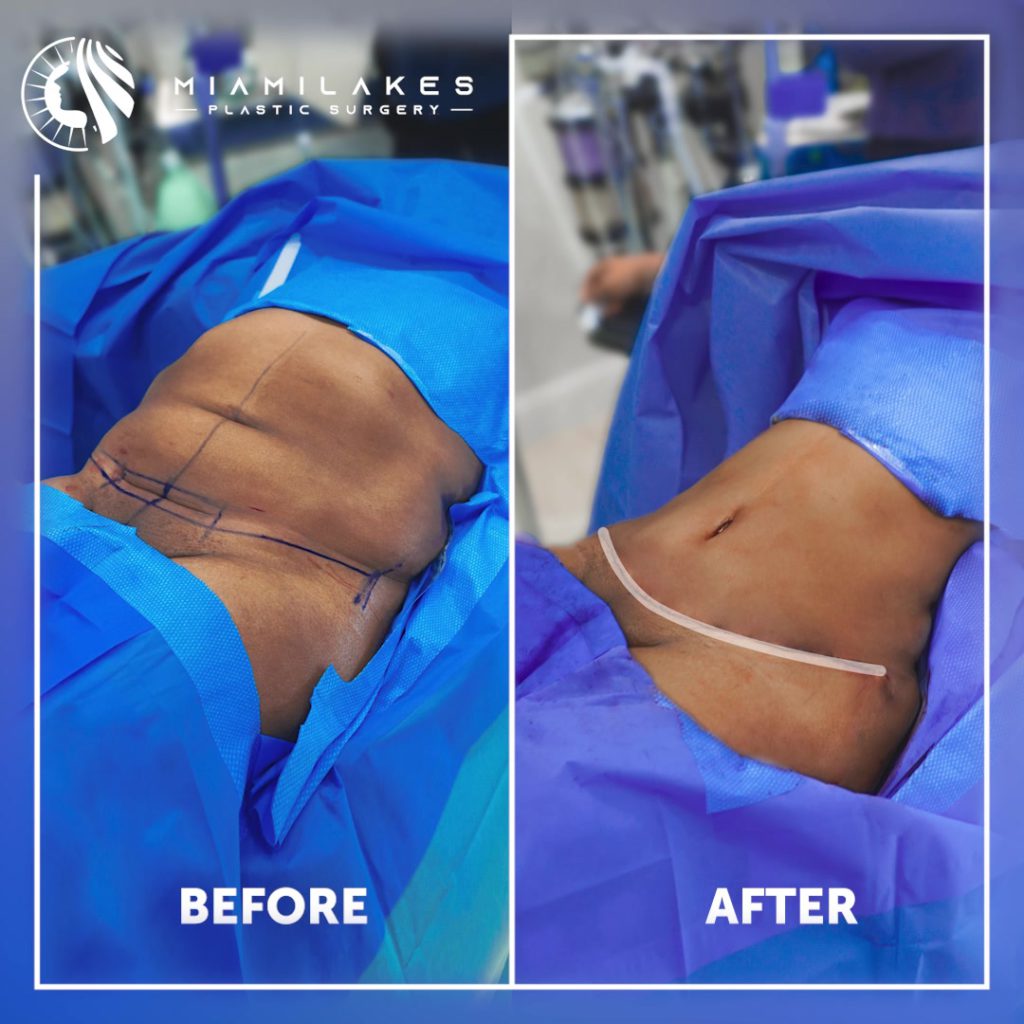 tummy tuck 2 06 09 2022