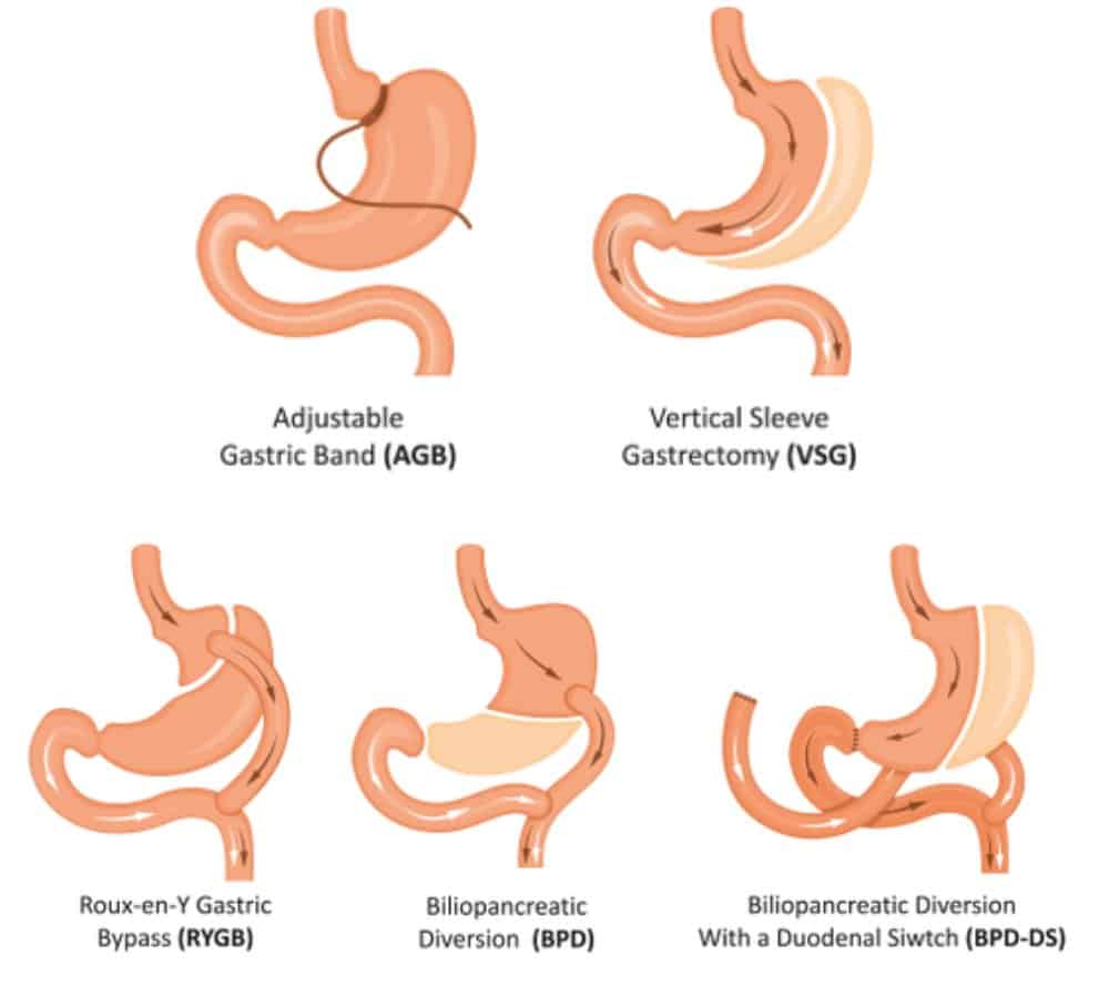 Types of Bariatric Surgery