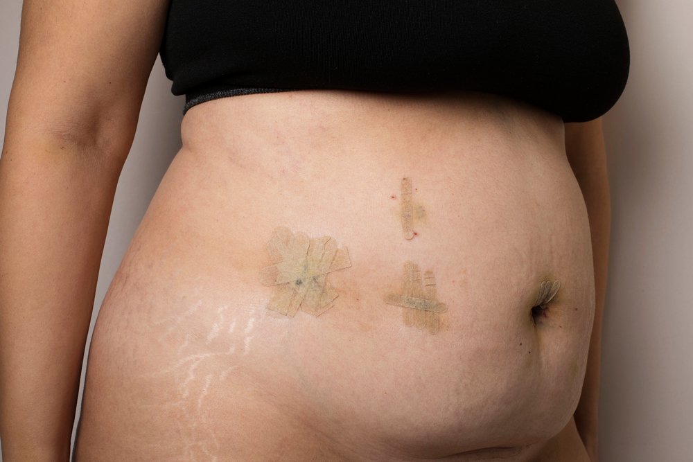 Woman abdominal stitches after bariatric surgery