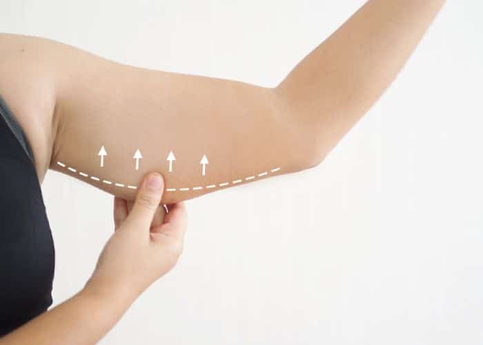 Arm Liposuction Miami 1