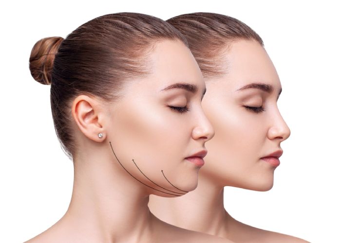 Chin Liposuction Miami