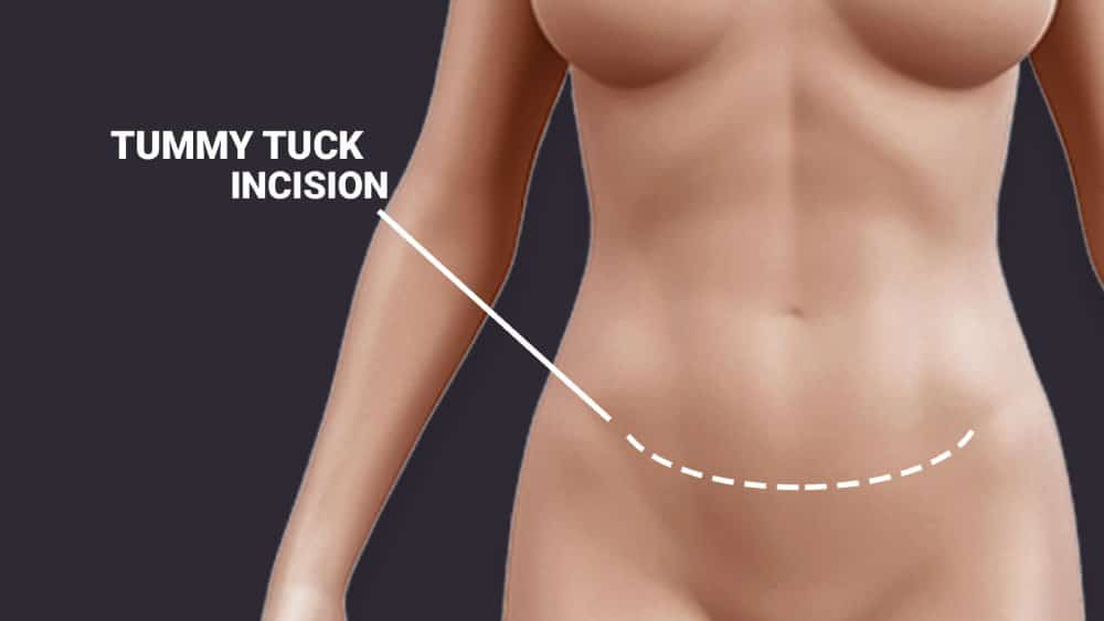 Tummy tuck with lipo on the flanks can create the hourglass shape -  Hourglass Tummy Tuck