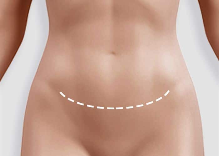 Tummy Tuck