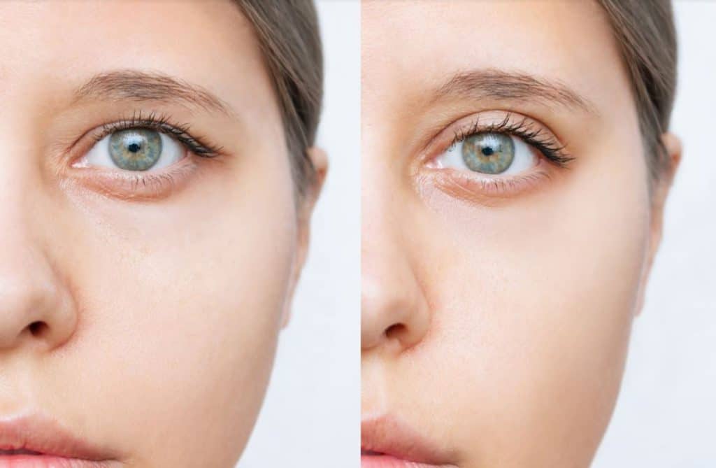 Eyelid surgery before and after photo