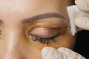 How to Remove Eyelid Surgery Scar