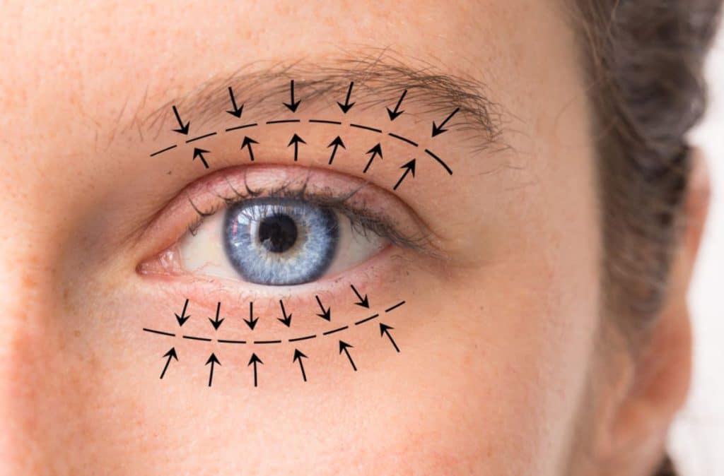 What Is Blepharoplasty Eyelid Surgery