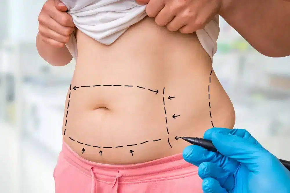 The Costs Mommy Makeover vs Tummy Tuck